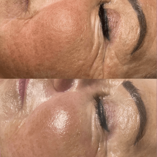 Chemical Peels